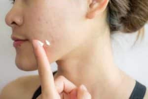 acne skin care tips